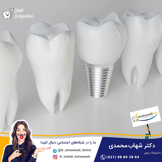 برندهای سازنده ایمپلنت دندان ایرانی - کلینیک دندانپزشکی دکتر شهاب محمدی